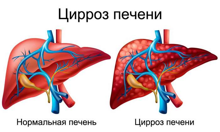 Диффузное изменение паренхимы печени и поджелудочной железы. Что это такое, лечение