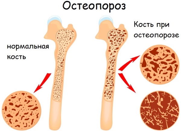 Фемостон 1\10, 2\10. Инструкция по применению, цена, аналоги