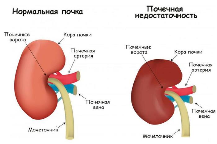 Фраксипарин. Инструкция по применению, цена, аналоги, отзывы