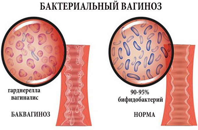 Гарднереллез у женщин. Симптомы и лечение, причины, препараты, народные средства, при беременности