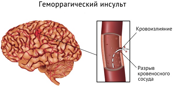 Васкулит фото у взрослых