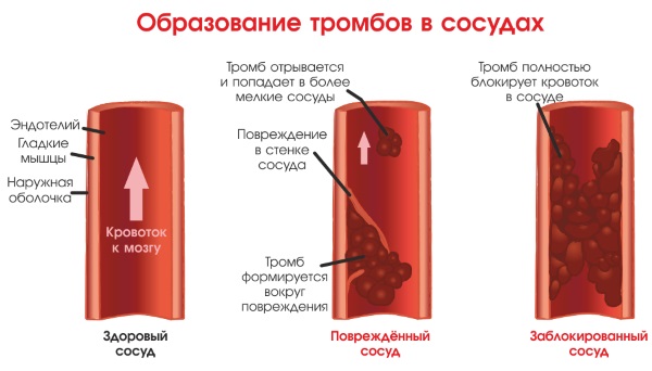 Гингобелоба. Инструкция по применению таблетки, настойка, трава