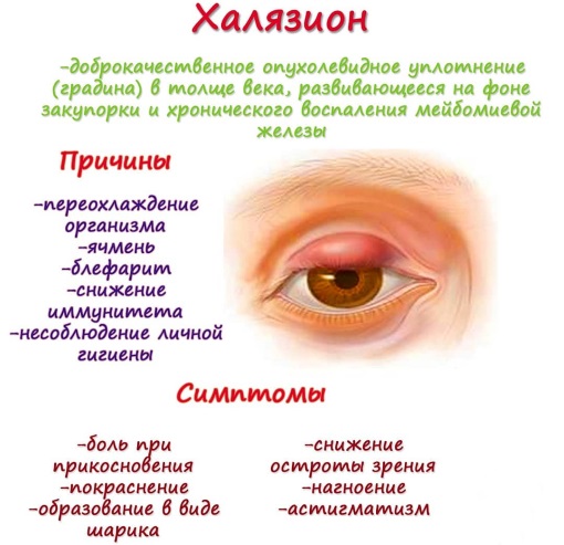 Халязионы век у взрослого. Что это такое, лечение народными средствами, медикаментозно, операция