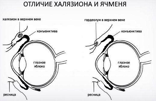 Халязионы век у взрослого. Что это такое, лечение народными средствами, медикаментозно, операция