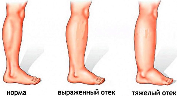 Как избавиться от отечности лица под глазами, тела, ног. Лекарства, народные средства