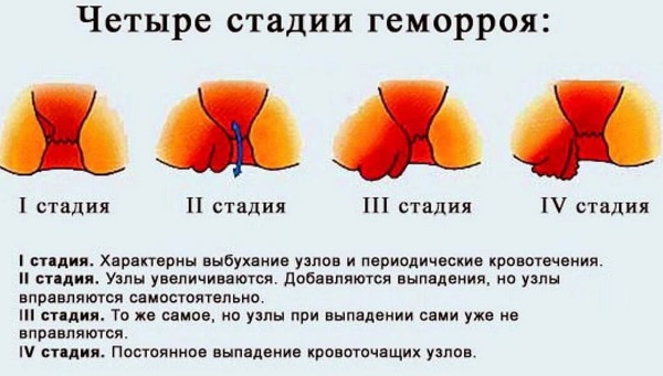 Как быстро и навсегда вылечить геморрой в домашних условиях