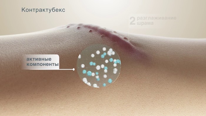 Контрактубекс и аналогичные препараты от шрамов и рубцов. Цена, отзывы