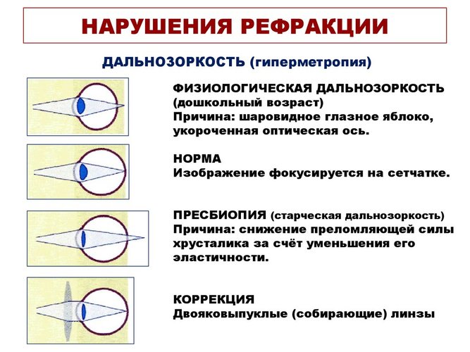 Угол косоглазия по гиршбергу картинки