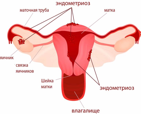 Линдинет 30 (Lindynette 30). Отзывы женщин, инструкция по применению, аналоги