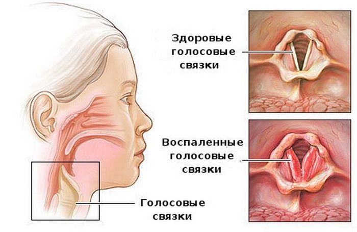 Ларинготрахеит у детей. Симптомы и лечение, клинические рекомендации