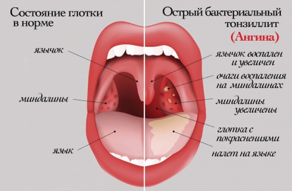 Ангина. Симптомы и лечение у взрослых, лекарства-антибиотики, народные средства