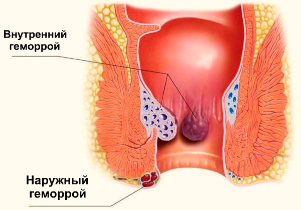 Лечение геморроя. Упражнения, свечи, народные и аптечные средства, диета в домашних условиях