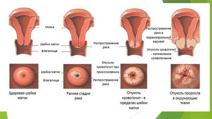 Впч у женщин гормоны thumbnail