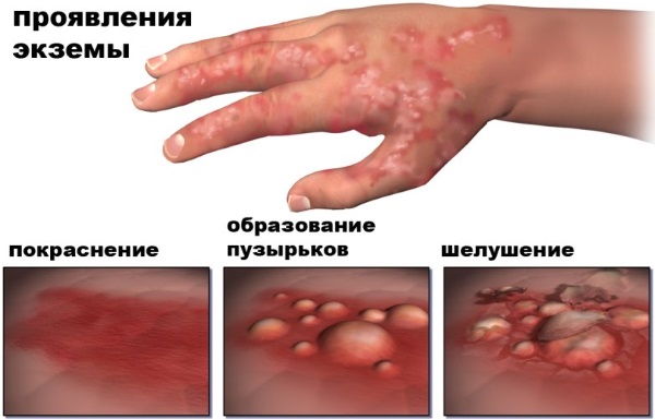 Мази от экземы на коже у взрослых. Список эффективных гормональные и негормональные