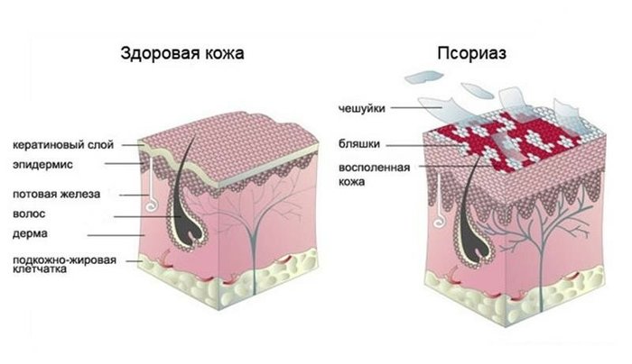 Лучшие мази от псориаза. Список негормональных, цены и отзывы