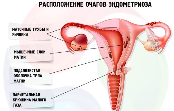 Месячные 2 раза в месяц. Причины после 40 лет, у подростков, после отмены Дюфастона, Постинора, при беременности