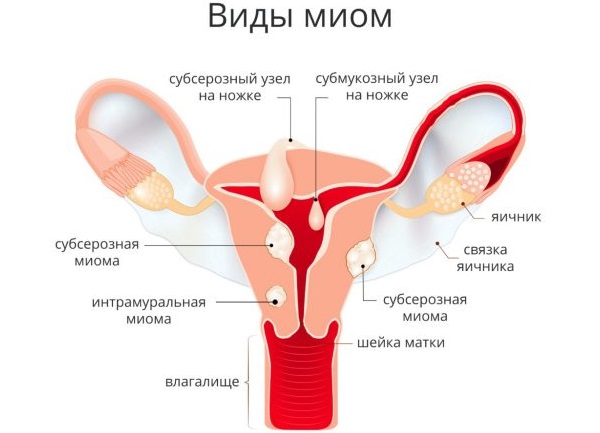 Месячные 2 раза в месяц. Причины после 40 лет, у подростков, после отмены Дюфастона, Постинора, при беременности