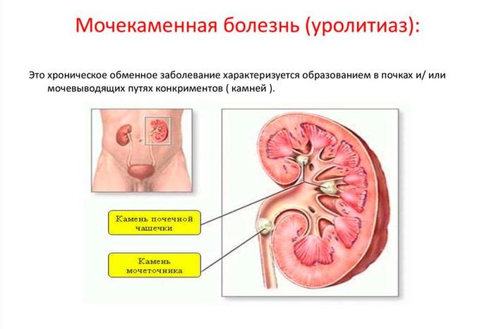 Мочекислый диатез. Что это такое, симптомы у женщин, мужчин, фото, диета, лечение, народные средства, препараты, травы