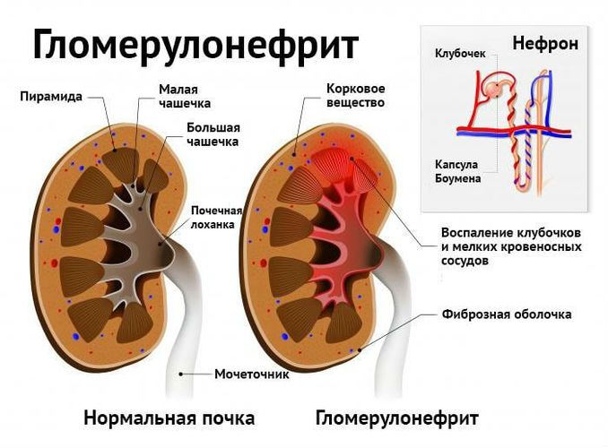 Мочевина в крови повышена. Причины, как лечить, симптомы, диета, народные средства, лекарства