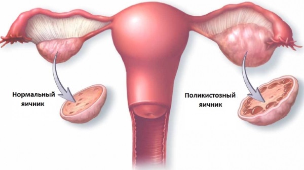 Почему нет месячных и нет беременности. Причины и что делать