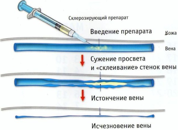 Операция на венах нижних конечностей лазером. Цена, как проходит, последствия