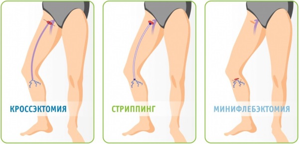 Операция на венах нижних конечностей лазером. Цена, как проходит, последствия