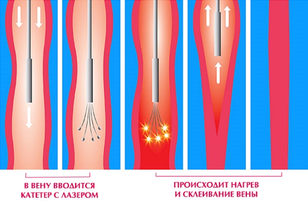 Операция на венах нижних конечностей лазером. Цена, как проходит, последствия