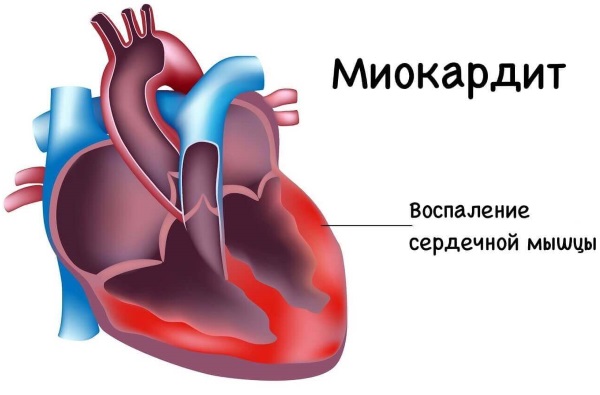 ОРВИ у детей. Симптомы и лечение, антибиотики, народные средства, рекомендации врачей