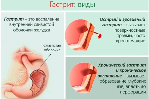 Острый гастрит. Симптомы и лечение у взрослых, диета, народные средства, лекарства