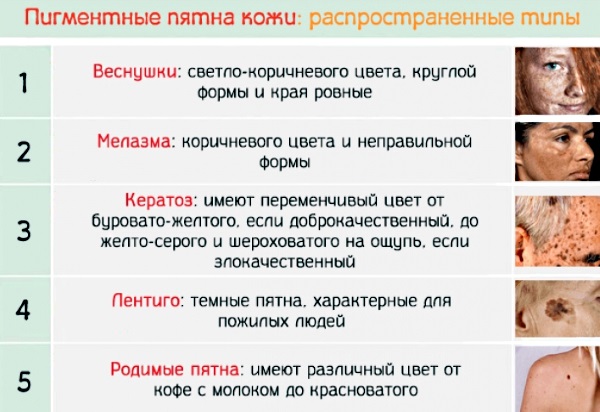 Пигментные пятна. Что это такое, от чего появляются на лице, руках, шее, как избавиться