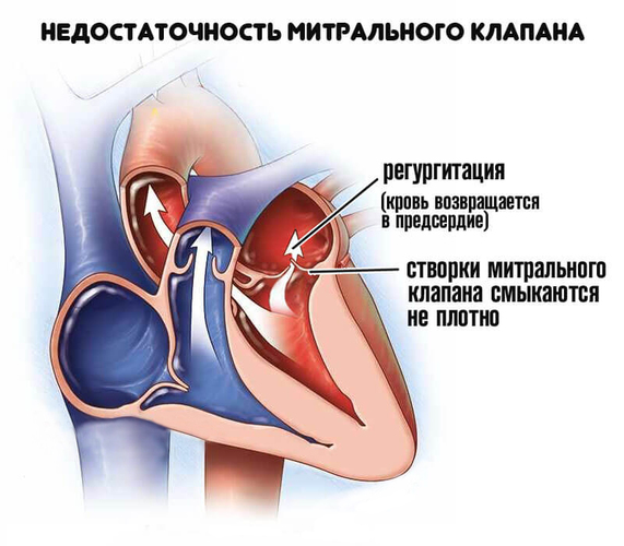 Прединфарктное состояние у женщин. Первые признаки, симптомы, лечение, ЭКГ, расшифровка