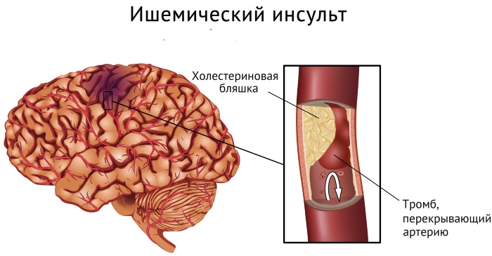 Реабилитация после инсульта. Упражнения, народные средства в домашних условиях