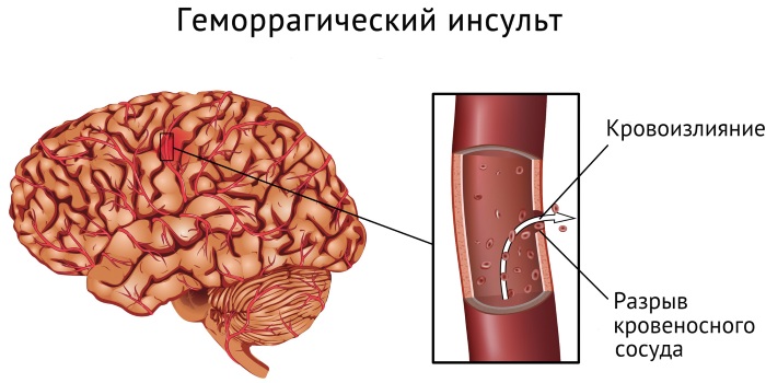 Инсульты. Какие бывают, виды и последствия