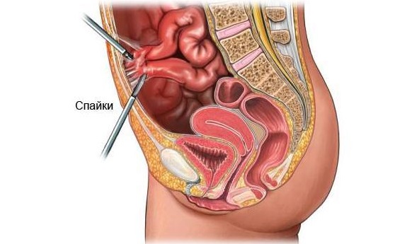 Спайки кишечника. Симптомы и лечение, народные средства, препараты, диета, упражнения