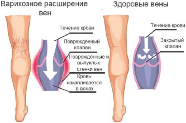 Лопаются сосуды (вены) на ногах. Почему, что делать