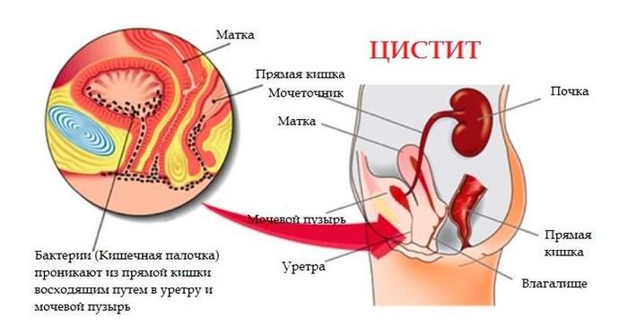 Тяжесть внизу живота у женщин. Причины перед месячными, менопаузе, климаксе, при беременности, лечение