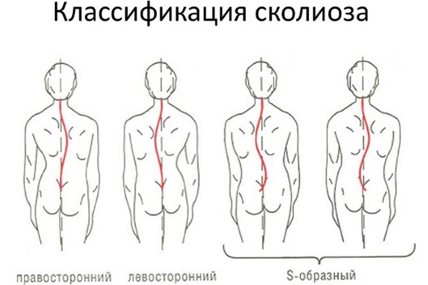 Упражнения от сколиоза для детей, 1-2 степени, по Бубновскому. Методики, как выполнять в домашних условиях