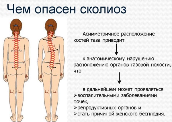 Упражнения от сколиоза для детей, 1-2 степени, по Бубновскому. Методики, как выполнять в домашних условиях