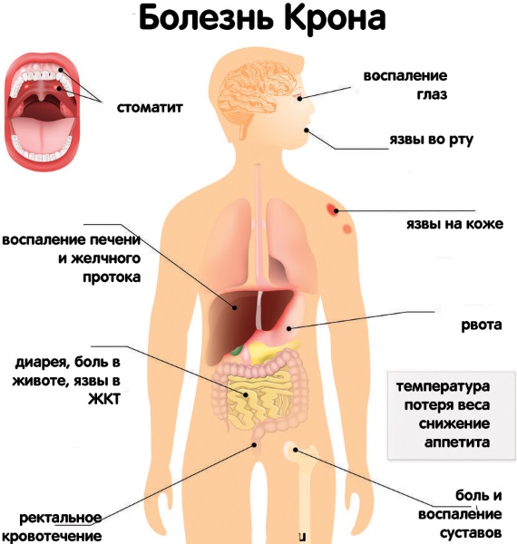 Воспаление кишечника. Симптомы и лечение. Народные средства, препараты, диета