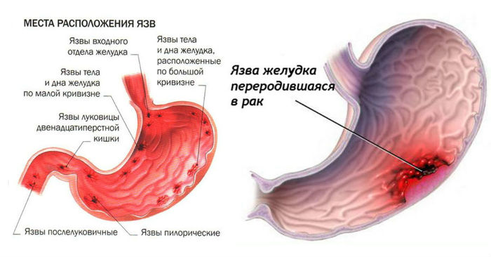 Язва желудка. Симптомы и проявление у взрослых, лечение, процедуры, операция