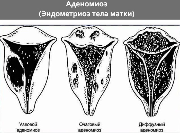 Аденомиоз матки. Симптомы и лечение, препараты, народные средства