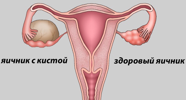 Аденомиоз матки. Симптомы и лечение, препараты, народные средства