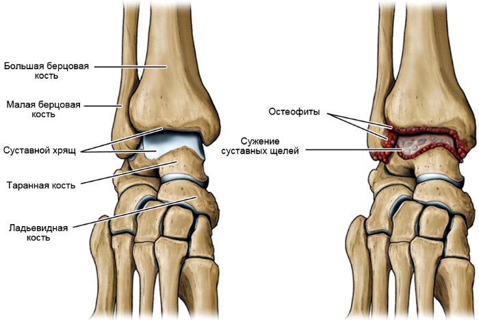 Артроз голеностопного сустава. Симптомы и лечение, средства, упражнения