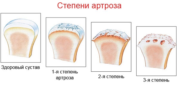 Артроз голеностопного сустава. Симптомы и лечение, средства, упражнения