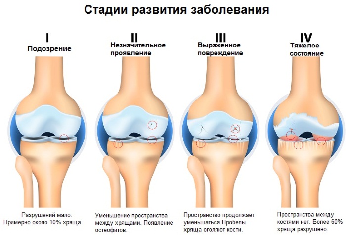 Артроз голеностопного сустава. Симптомы и лечение, средства, упражнения