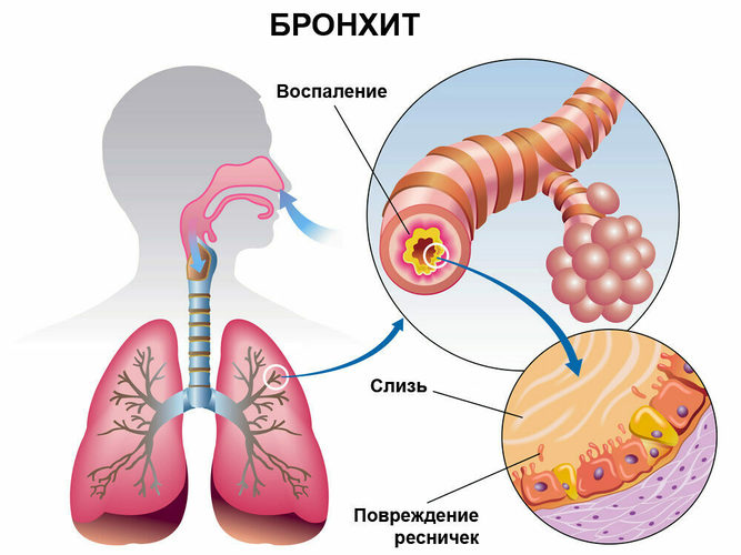 Боль в грудной клетке слева: при вдохе, выдохе, дыхании и при движении