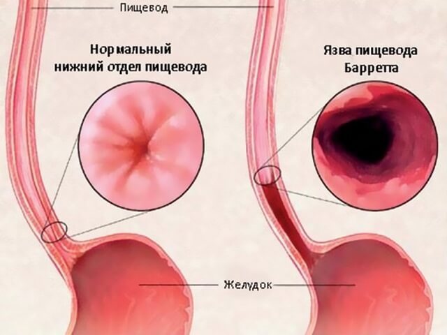 Боль в грудной клетке посередине при кашле, нажатии, вдохе, движении. Причины и что делать