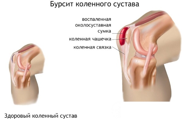 Боль в колене. Причины при ходьбе, сгибании и разгибании, лечение