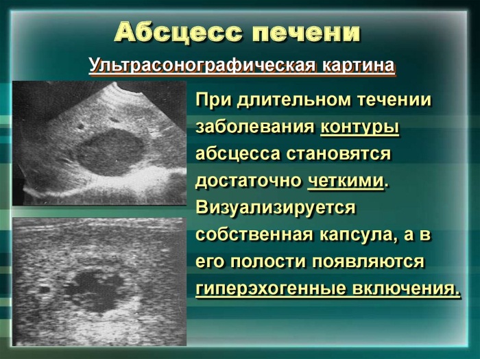 Боль в печени. Симптомы и лечение, как снять народными средствами, лекарствами