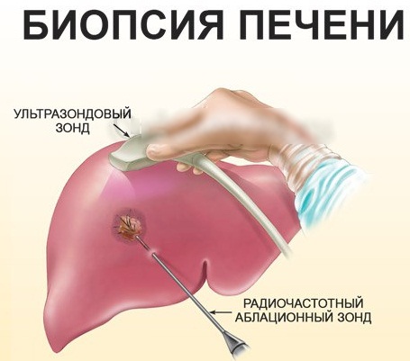 Боль в печени. Симптомы и лечение, как снять народными средствами, лекарствами